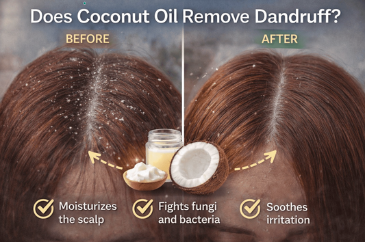 Does Coconut Oil Remove Dandruff? Benefits, Risks, How To!